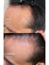 マーブル 熊本合志店/育毛促進【30代男性】