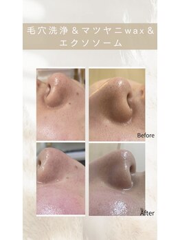 メリナ(Melina)/毛穴洗浄&マツヤニ&エクソソーム