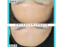 アクト クロ(ACT curro)/【フェイシャル】施術例