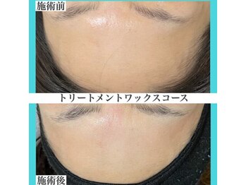 アクト クロ(ACT curro)/【フェイシャル】施術例