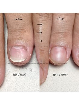 メンズ深爪矯正　長さ出し