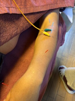 ライズ/腕への鍼施術