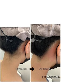 メディカルサロンドオフ 堺東店(medical salon de off)/うなじ襟足脱毛♪