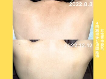 エクレ 柏店(EKURE)/レディース背中脱毛