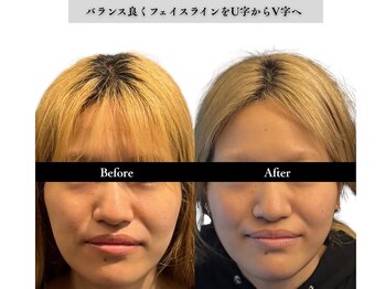 アロエベル(aloe Belle)/Before After（4回施術）