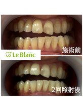 ルブラン 奈良店(Le Blanc)/黄ばみが気になってきたら