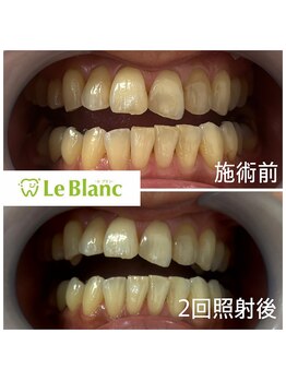 ルブラン 奈良店(Le Blanc)/黄ばみが気になってきたら