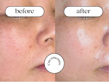 ユヌランコント 岐阜店(Une rencontre)/ハーブ＆ジュエリーピーリング