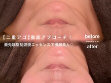 ソワン ド ブランシュ ライフ八戸ノ里店(Soin de Blanche)/【二重アゴ】徹底アプローチ！