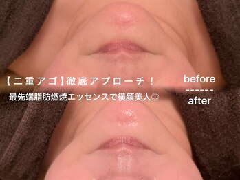 ソワン ド ブランシュ ライフ八戸ノ里店(Soin de Blanche)/【二重アゴ】徹底アプローチ！