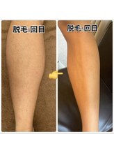 ブリリアント(Brilliant)/脱毛実績4 メンズ脚