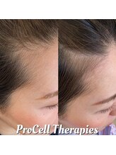 ラナン パラフューズ(Ranun's PARAFUSE.)/プロセル頭皮トリートメント