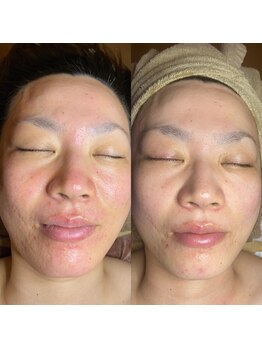 キラディ(KILADY)/肌質感でお悩みの方にも必見！