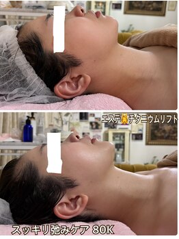 アルページュ(Arpege)/弛みケア♪小顔チタニウム80K