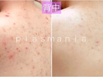 イノエ(inoe)/【背中ニキビ】