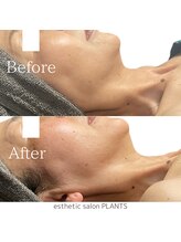 プランツ(PLANTS)/50代／１回／首凝りたるみ