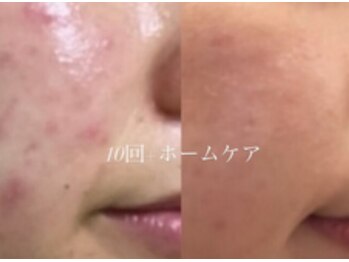 オーシャンブルーム 目黒(OceanBloom)/アンストレスニキビ