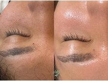 フラーブ(Flourb)/ハーブピーリング｜症例写真