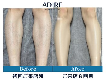 アディール(adire)/【足脱毛】ビフォーアフター