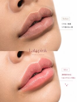 ルボーテ(Re beaute)の写真/隠す黒ずみから、魅せる素肌へ☆黒ずみだけではなく、黒ずみが起こる肌環境を極限に追求!