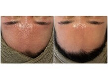 ロンサール(RONSARD)の雰囲気(何をしても改善しなかった毛穴の開き・赤みが1年で変化)
