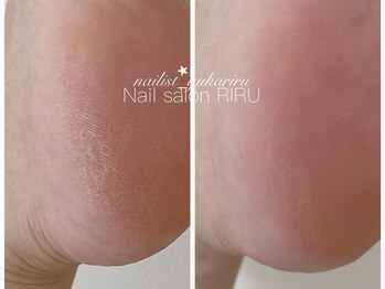 リル(RIRU)/角質ケア/フットケア