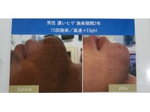 クローバー(clover)/ひげ脱毛