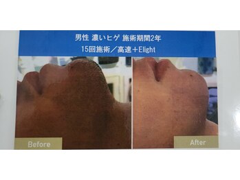 クローバー(clover)/ひげ脱毛