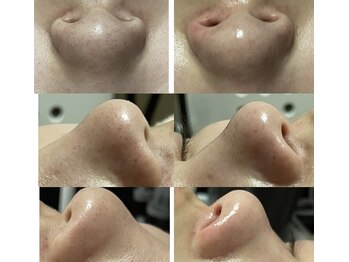 ファミリーセルフサロン 輪(Wa)/輪式3D黒ずみ・角栓毛穴洗浄