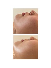 エモベーシック(e'MO BASIC)/漢方ハーブピーリング