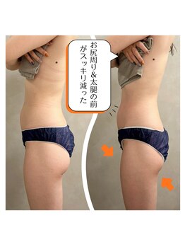 スリモア(SLIMORE)/ビフォーアフター☆お尻/もも