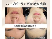 イーラボ 池袋店(e-LABO)/毛穴洗浄×国産ハーブピーリング