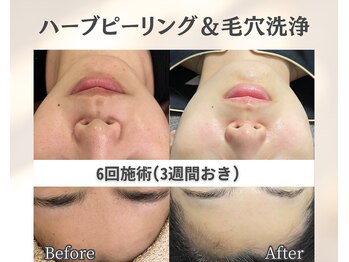 イーラボ 池袋店(e-LABO)/毛穴洗浄×国産ハーブピーリング