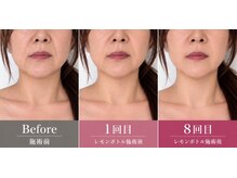 ブリリアントスマイルの雰囲気（レモンボトル5回目でたるみ二重顎がスッキリ）