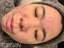 トップスキン 久屋大通(TOPSKIN)/最新のハーブピーリングで肌改善