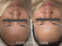 スピカ(SPICA)/美白美容液使用