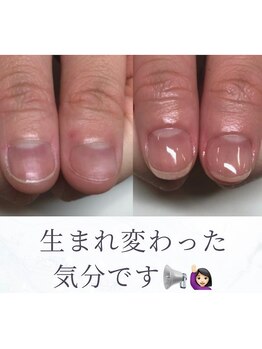 ティアラネイル 宇都宮/深爪矯正