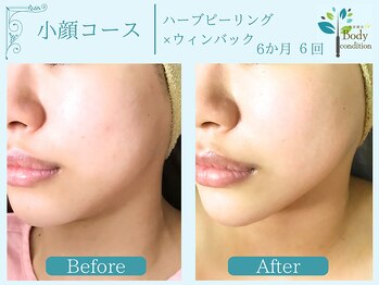 ボディコンディション/小顔/痩身/ウィンバック毛穴洗浄