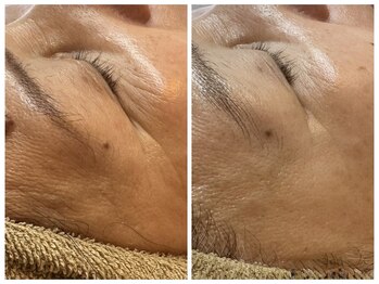 アルマ(ALMA)/垢を取って気になる小ジワ改善!