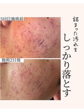 アネラ(Anela)/汚れを落とすことの大事さ