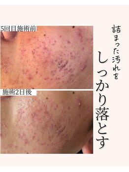 アネラ(Anela)/汚れを落とすことの大事さ