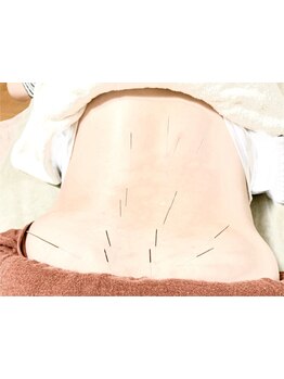 鍼灸施術を受けたい