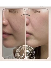 エヌ スタイル(N Style)/リベルハーブピーリング 