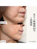 【驚愕濃度でリフトアップ】生ヒト幹細胞50％＋立体造顔美容鍼　￥20,000→