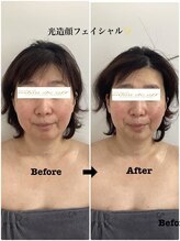 メディカルサロンドオフ 堺東店(medical salon de off)/光造顔フェイシャル★　施術前後