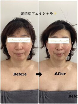 メディカルサロンドオフ 堺東店(medical salon de off)/光造顔フェイシャル★　施術前後