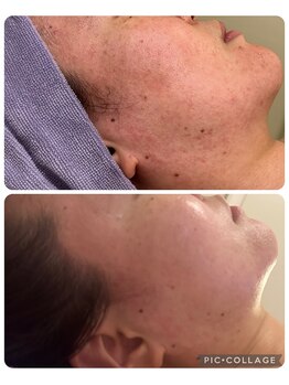 ルピナージュ(Lupinage)/【肌質改善】ー赤み/ごわつきー