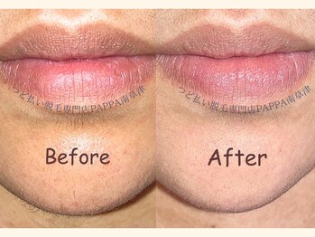 パッパ(PAPPA)/タマゴ肌顔脱毛が人気☆