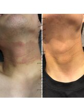 ナビ(NAVI)/赤み、乾燥