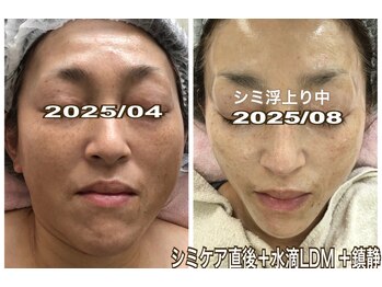 アルページュ(Arpege)/童顔ホワイト♪SPシミケア★